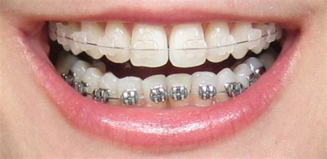 ceramic vs metal brackets|ceramic braces top metal bottom.